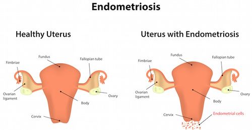 endometriosi e dolore allo stomaco endometriosi e dolore allo stomaco